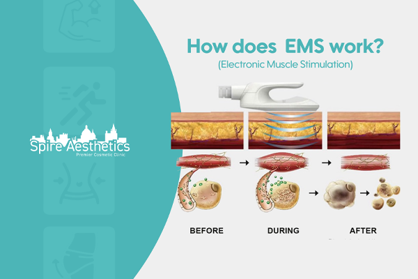 EMS treatment for post pregnancy weight loss treatment Tipton