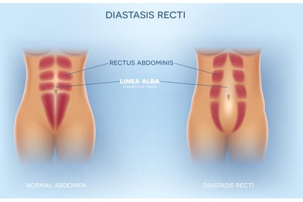 What Non-Surgical Options Are Available for Diastasis Recti Tipton?