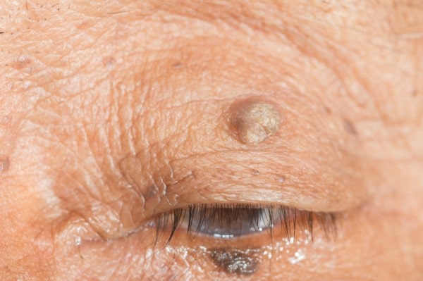 Skin imperfections Tipton - Cryopen is fast and effective book in today!