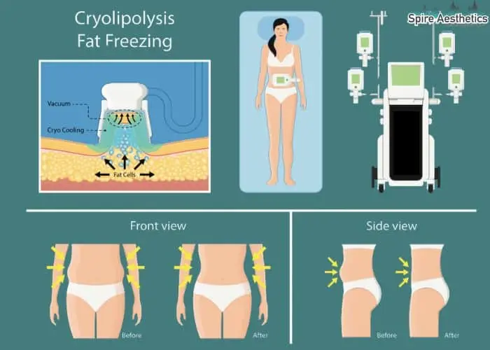 Fat freezing treatment Tipton benefits for competitions to remove stubborn fat deposits.