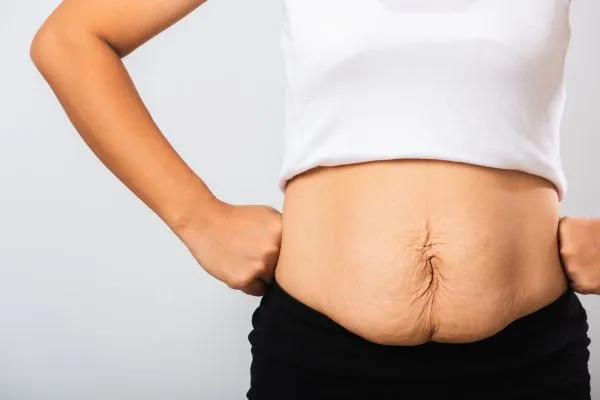 Image of a woman's stomach after weight loss with sagging skin following a gastric band Tipton