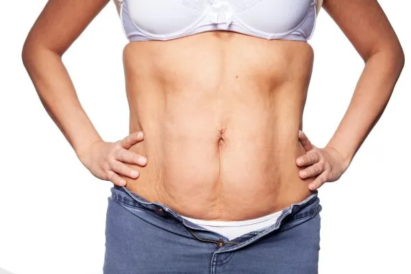 sagging skin on woman's stomach after weight loss injections Tipton
