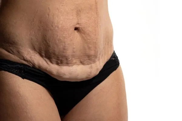 Image of womans stomach after weight loss injections Tipton showing saggy skin
