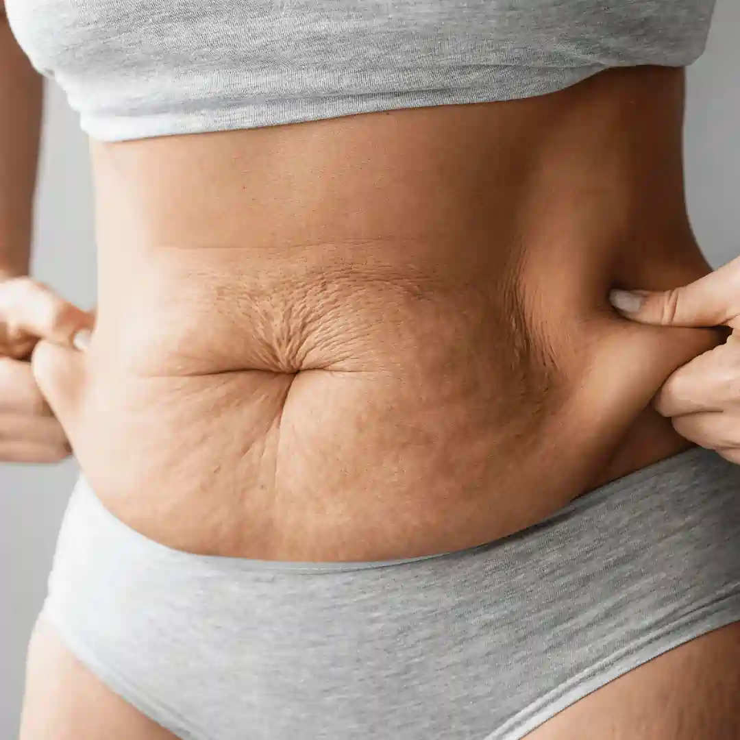 Is It Normal to Have Loose Skin After Pregnancy Tipton?