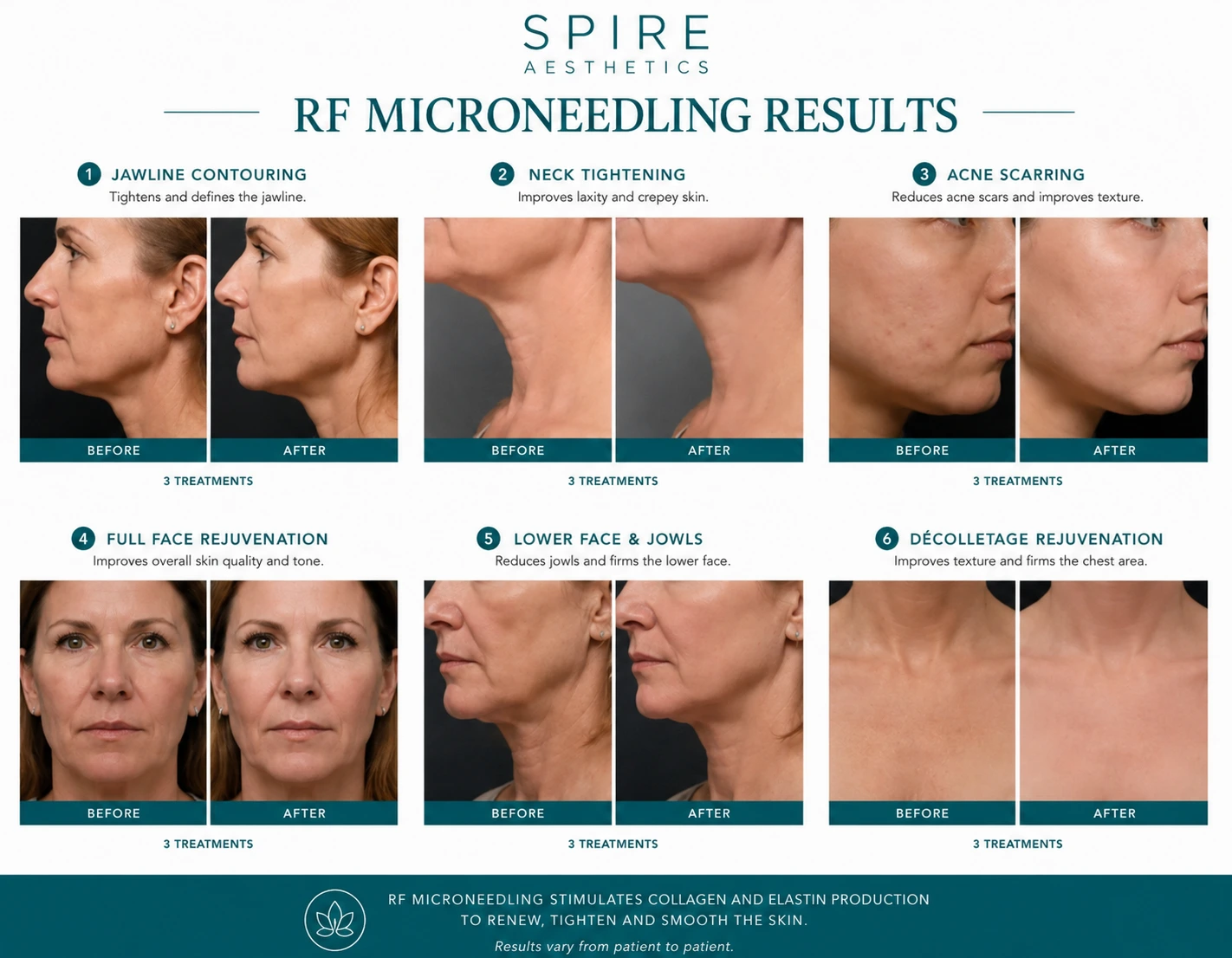 RF Microneedling Skin tightening Tipton results