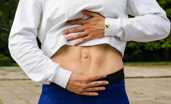 When Could Diastasis Recti Be the Missing Piece of the Puzzle Tipton?